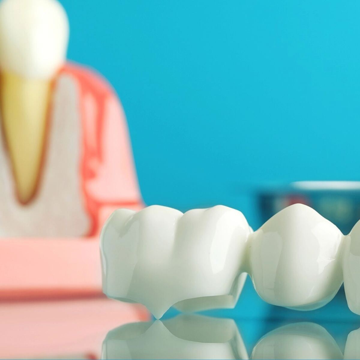 Dental Crowns & Bridges
