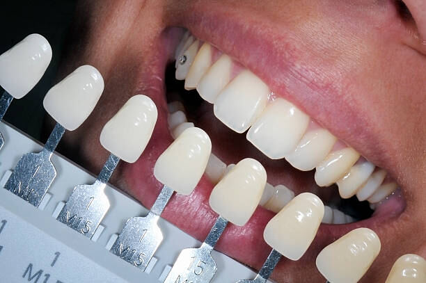 Professional Whitening Treatment